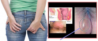 Illustration for article titled Apakah Obat Fistula Ani